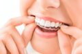 Dental Aligners_ A Simple Way to Get a Perfect Smile